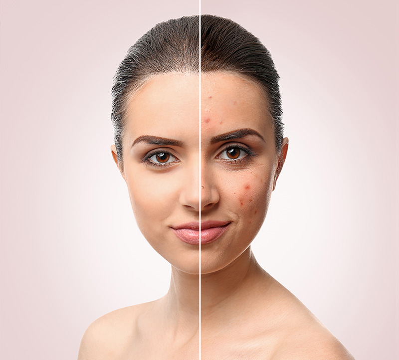 cea mai bună îngrijire a pielii împotriva îmbătrânirii și acneei