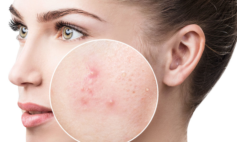 Sfaturi care te ajuta in lupta contra acneei